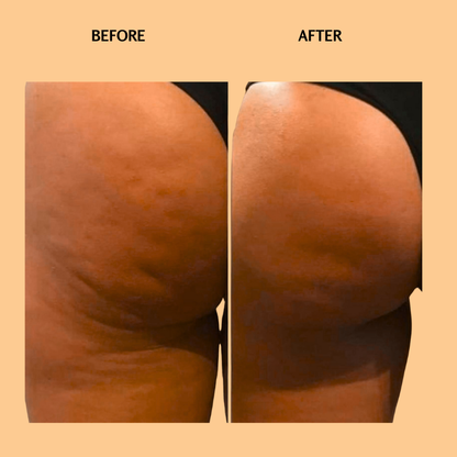 EarthEase™ Cellulite Massage Oil